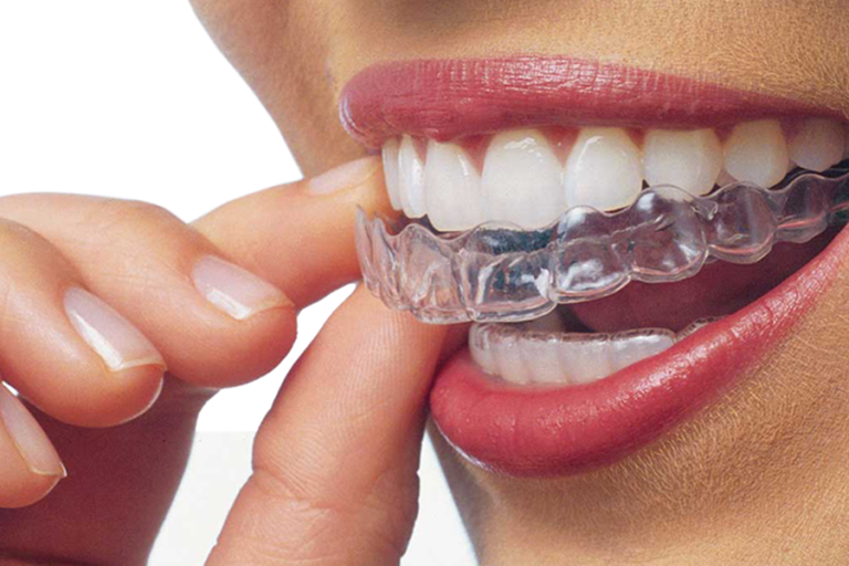 apparecchi denti invisibili
