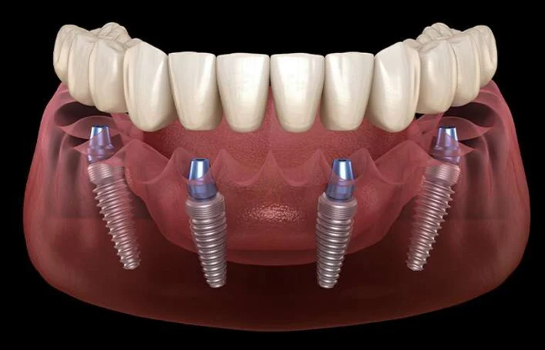 Impianti Dentali in Albania